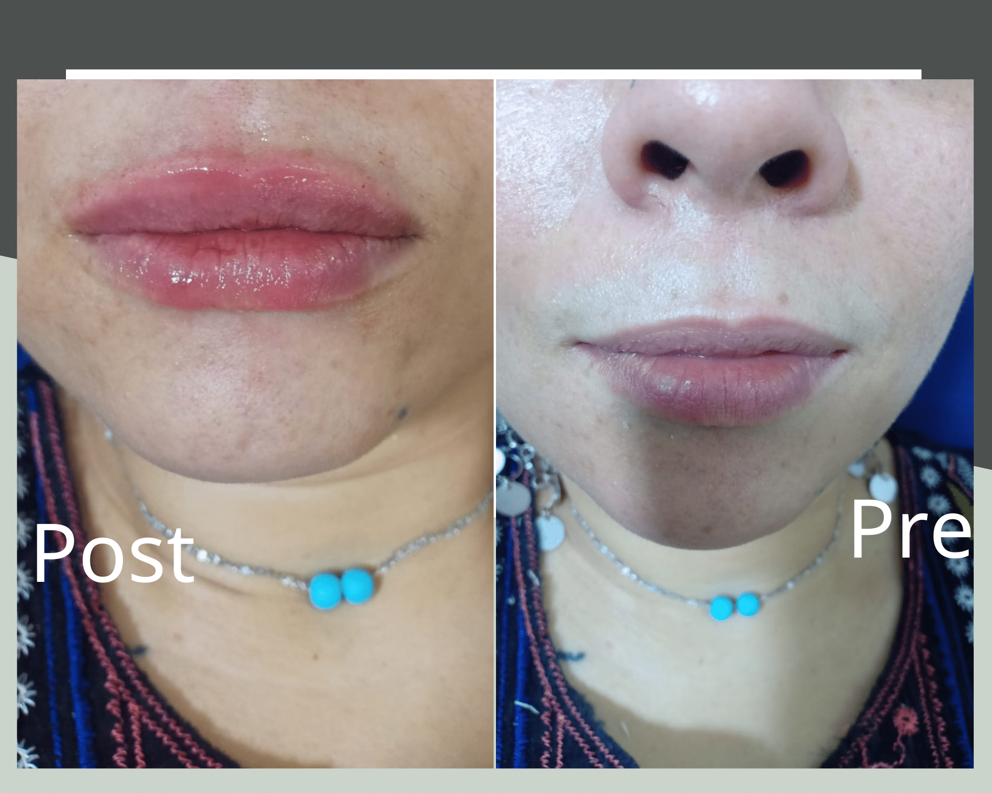 Lip Augmentation Filler in Hurghada